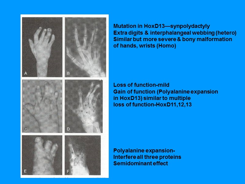 Mutation in HoxD13—synpolydactyly Extra digits & interphalangeal webbing (hetero) Similar but more severe & Mutation in HoxD13—synpolydactyly Extra digits & interphalangeal webbing (hetero) Similar but more severe &